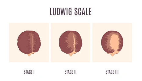 female ludwig scale