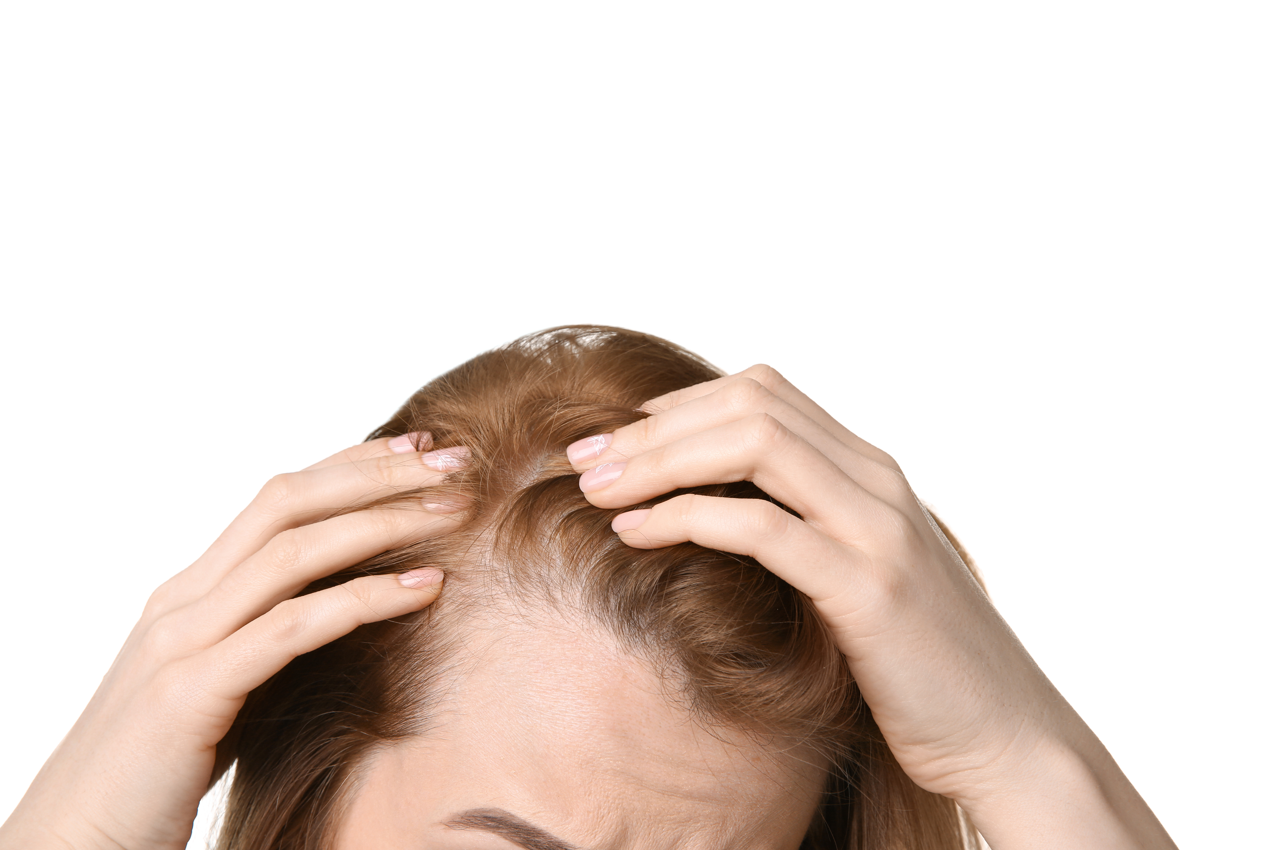 female hair loss girls
